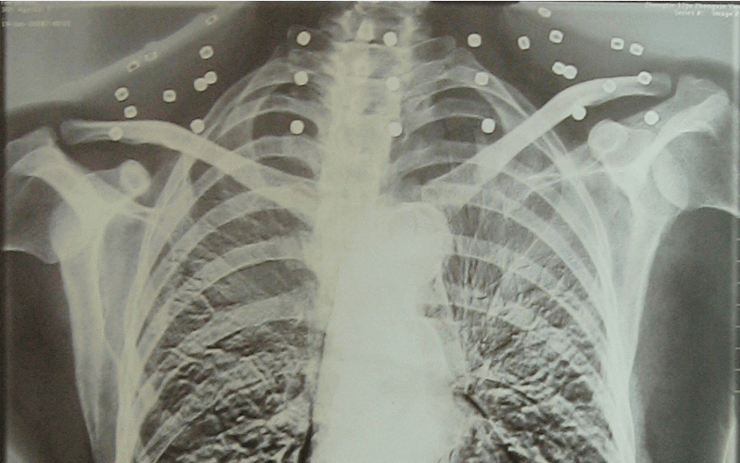 “老先生，您把项链取下来再做CT”